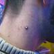 implant06