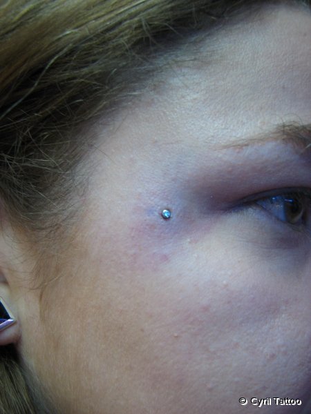 implant07
